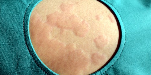 Things You Should Know About Hives (Urticaria): Causes, Symptoms And Diagnosis